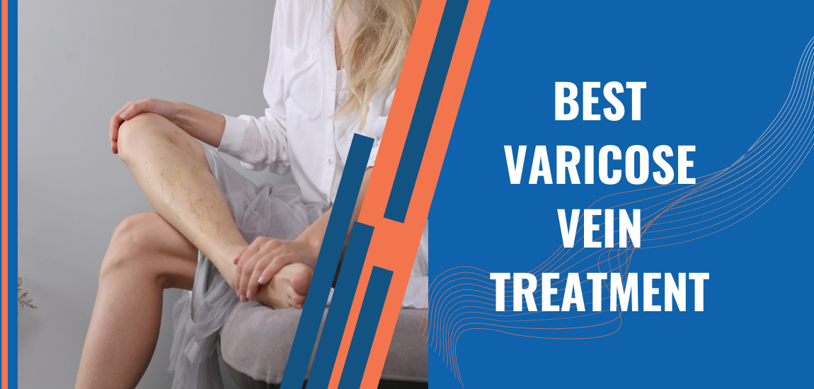 best varicose vein treatment