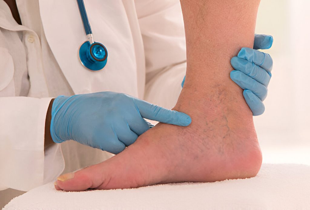 Reticular Veins