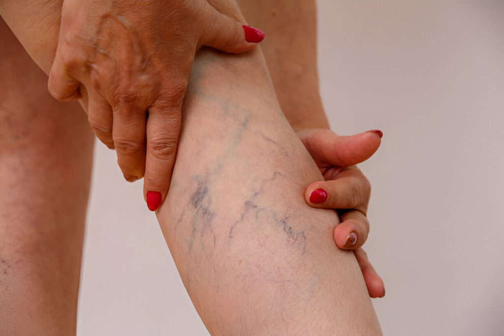 varicose veins self-care tips