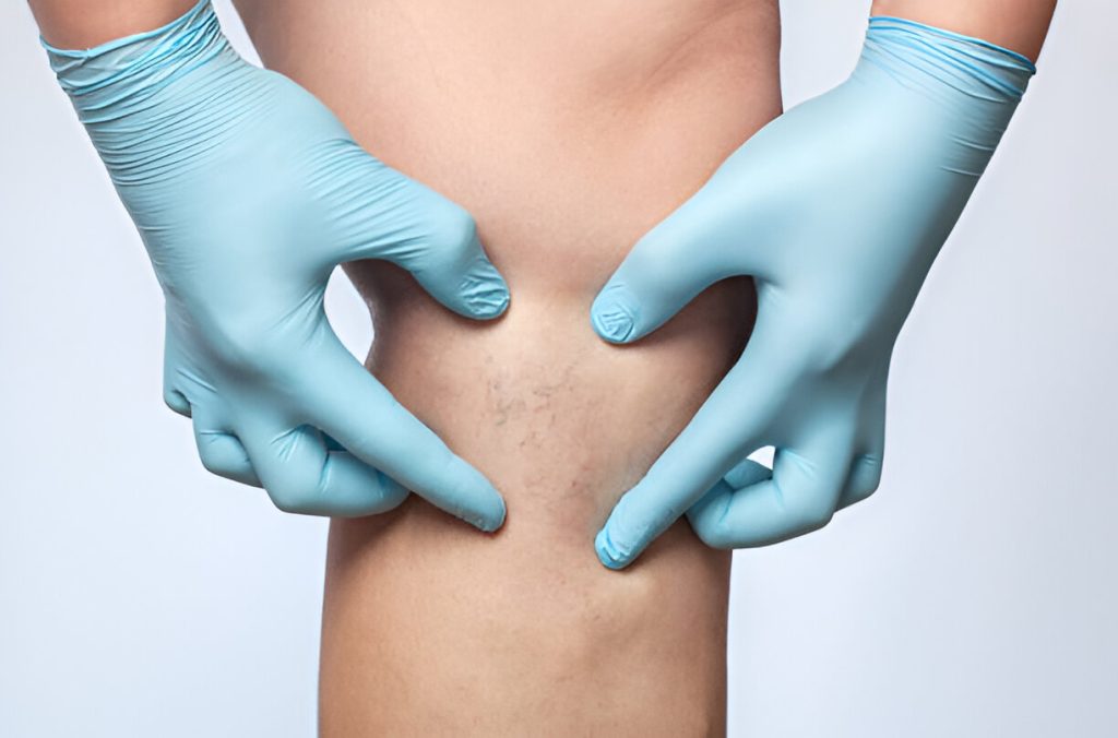 DVT vs Varicose Veins