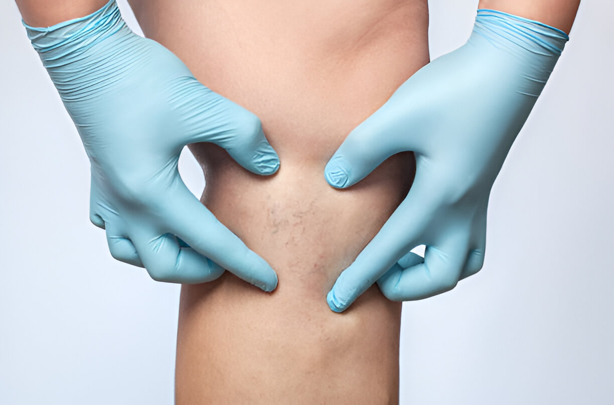 DVT vs Varicose Veins