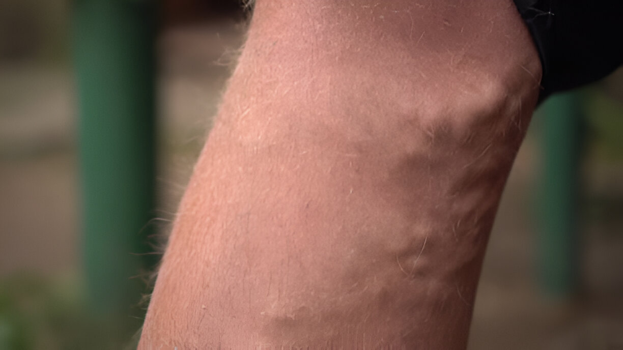 what does it mean when your veins pop out