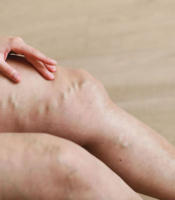 Will Spider Veins Go Away After Pregnancy