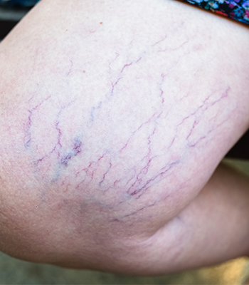 Spider Veins Pregnancy