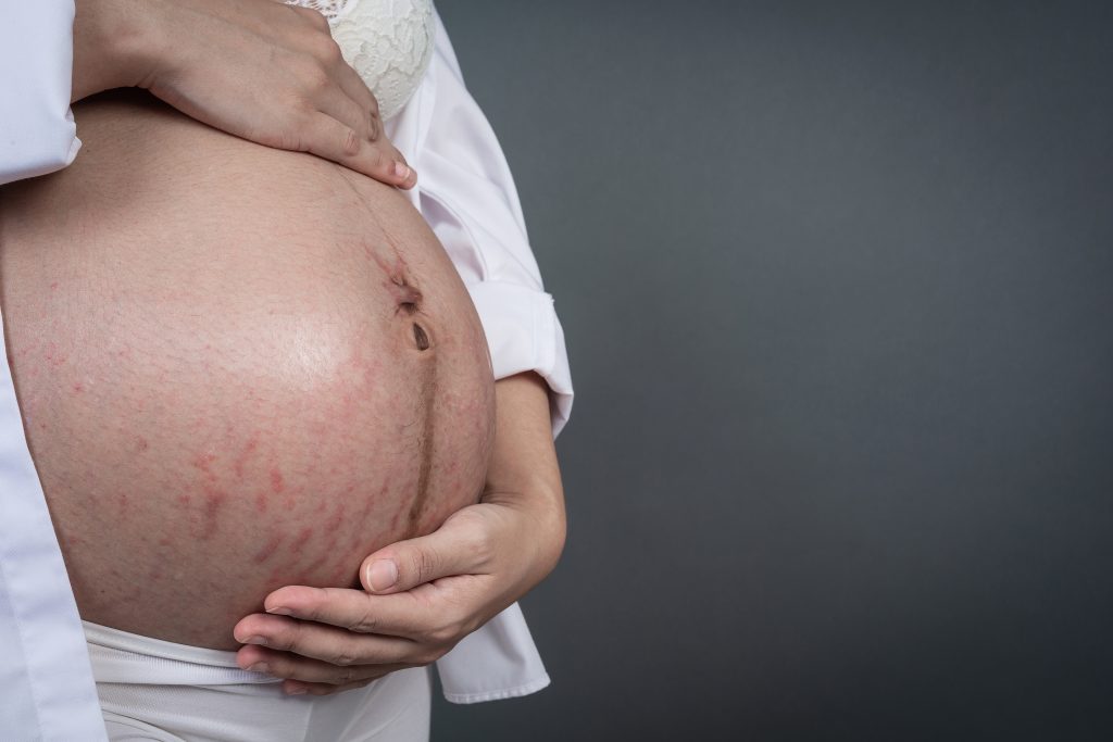 What to Know About Spider Veins During Pregnancy