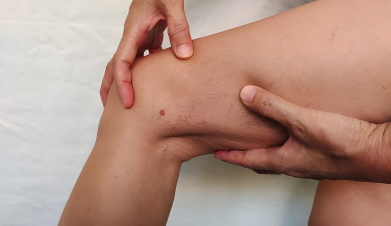 Best Varicose Vein Treatment