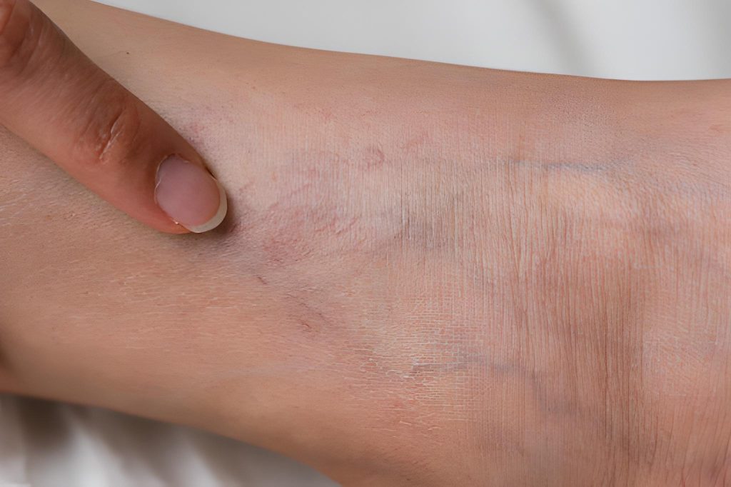 Can my Spider Veins put my health in danger?