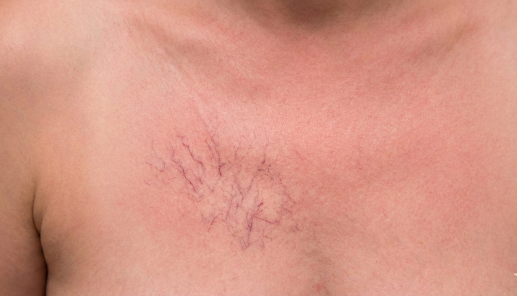 Spider Veins On Chest