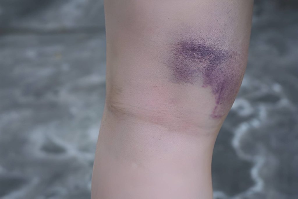 Why Are My Legs Purple And Blotchy