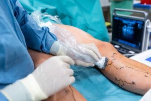 What Is The Laser-Based Vein Treatment